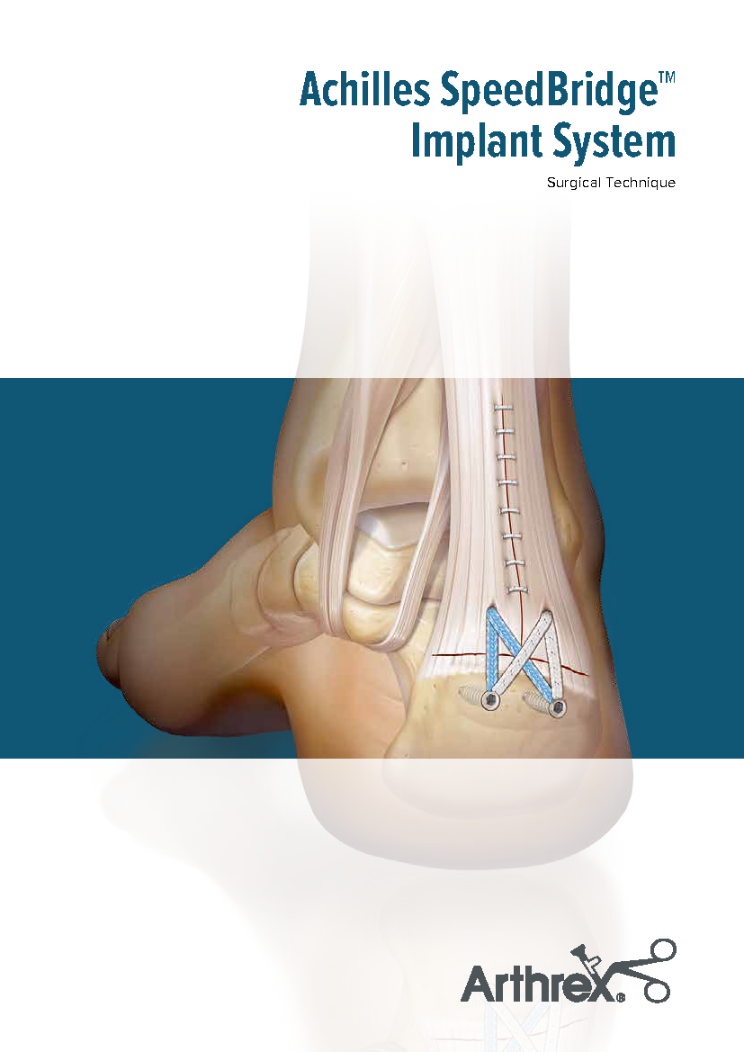 医療従事者確認 | SwiveLock™(アキレス腱) | Foot & Ankle
