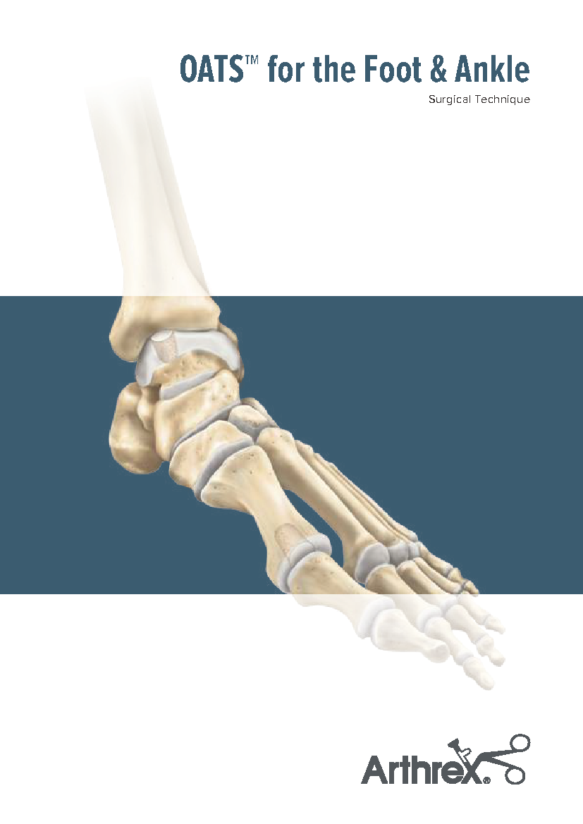 医療従事者確認 | OATS™ | Foot & Ankle | Arthrex 医療従事者確認 | OATS™ | Foot & Ankle | Arthrex