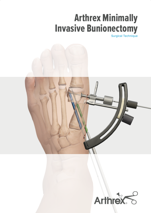 LT7-000195-ja-JP_A_ Arthrex Minimally Invasive Bunionectomy Surgical Technique_Final